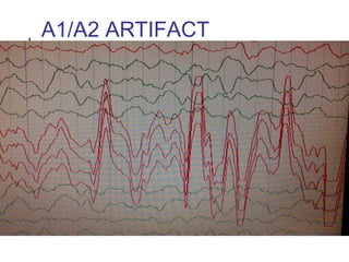A1/A2 ARTIFACT
 