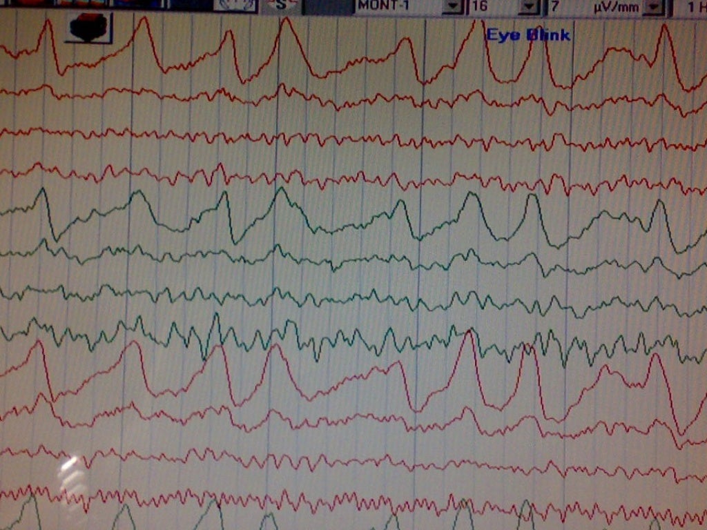 What Are Normal Eeg Variants? , Normal Variants and Unusual EEG ...