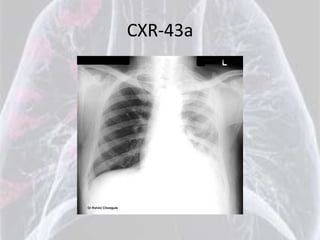 CXR-43a
 