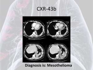 CXR-43b




Diagnosis is: Mesothelioma
 