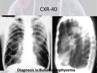 CXR-40




Diagnosis is:Bullous Emphysema
 