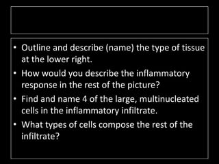 • Outline and describe (name) the type of tissue
  at the lower right.
• How would you describe the inflammatory
  response in the rest of the picture?
• Find and name 4 of the large, multinucleated
  cells in the inflammatory infiltrate.
• What types of cells compose the rest of the
  infiltrate?
 