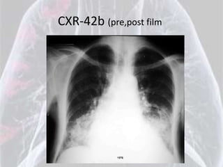 CXR-42b (pre,post film
 
