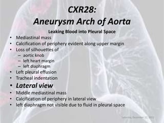 CXR28:
            Aneurysm Arch of Aorta
                   Leaking Blood into Pleural Space
• Mediastinal mass
• Calcification of periphery evident along upper margin
• Loss of silhouettes of
    – aortic knob
    – left heart margin
    – left diaphragm
• Left pleural effusion
• Tracheal indentation
• Lateral view
• Middle mediastinal mass
• Calcification of periphery in lateral view
• left diaphragm not visible due to fluid in pleural space

                                                        Saturday, December 22, 2012
 