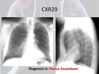 CXR29




Diagnosis is: Pectus Excavatum
 
