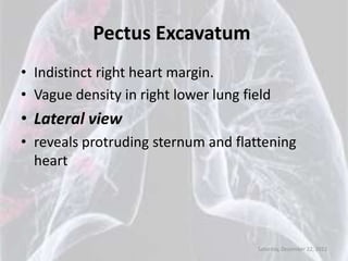 Pectus Excavatum
• Indistinct right heart margin.
• Vague density in right lower lung field
• Lateral view
• reveals protruding sternum and flattening
  heart




                                      Saturday, December 22, 2012
 
