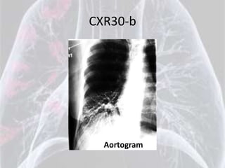CXR30-b




  Aortogram
 