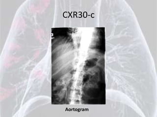 CXR30-c




Aortogram
 