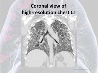 Coronal view of
high-resolution chest CT




                      Saturday, December 22, 2012
 