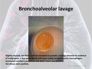 Bronchoalveolar lavage




Slightly mucoid, tan fluid; cultures revealed no growth; cytology showed no evidence
of malignancy; a few white blood cells were noted, predominantly macrophages;
laminated calcified concretions and debris were also present.
Von Kossa stain positive.
                                                                 Saturday, December 22, 2012
 