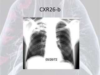 CXR26-b
 