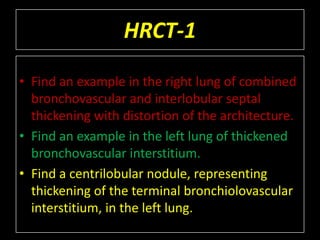 HRCT-1

• Find an example in the right lung of combined
  bronchovascular and interlobular septal
  thickening with distortion of the architecture.
• Find an example in the left lung of thickened
  bronchovascular interstitium.
• Find a centrilobular nodule, representing
  thickening of the terminal bronchiolovascular
  interstitium, in the left lung.
 