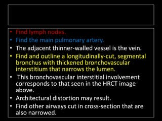 • Find lymph nodes.
• Find the main pulmonary artery.
• The adjacent thinner-walled vessel is the vein.
• Find and outline a longitudinally-cut, segmental
  bronchus with thickened bronchovascular
  interstitium that narrows the lumen.
• This bronchovascular interstitial involvement
  corresponds to that seen in the HRCT image
  above.
• Architectural distortion may result.
• Find other airways cut in cross-section that are
  also narrowed.
 