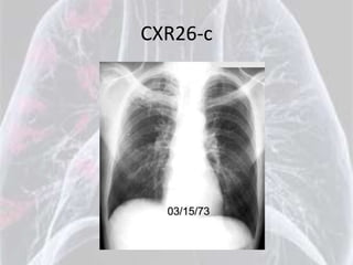 CXR26-c
 