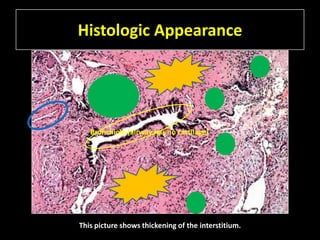 Histologic Appearance




   Bronchiole (airway has no cartilage)




This picture shows thickening of the interstitium.
 