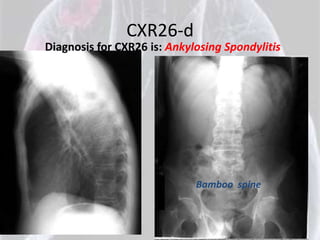 CXR26-d
Diagnosis for CXR26 is: Ankylosing Spondylitis




                             Bamboo spine
 