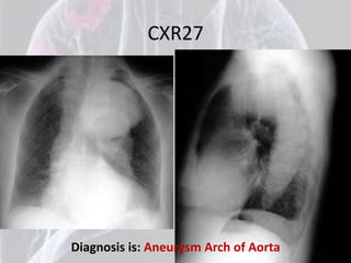 CXR27




Diagnosis is: Aneurysm Arch of Aorta
 
