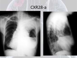 CXR28-a
 