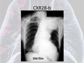 CXR28-b




Old film
 