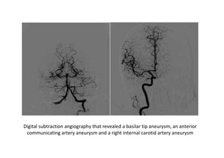Digital subtraction angiography that revealed a basilar tip aneurysm, an anterior
 communicating artery aneurysm and a right internal carotid artery aneurysm
 
