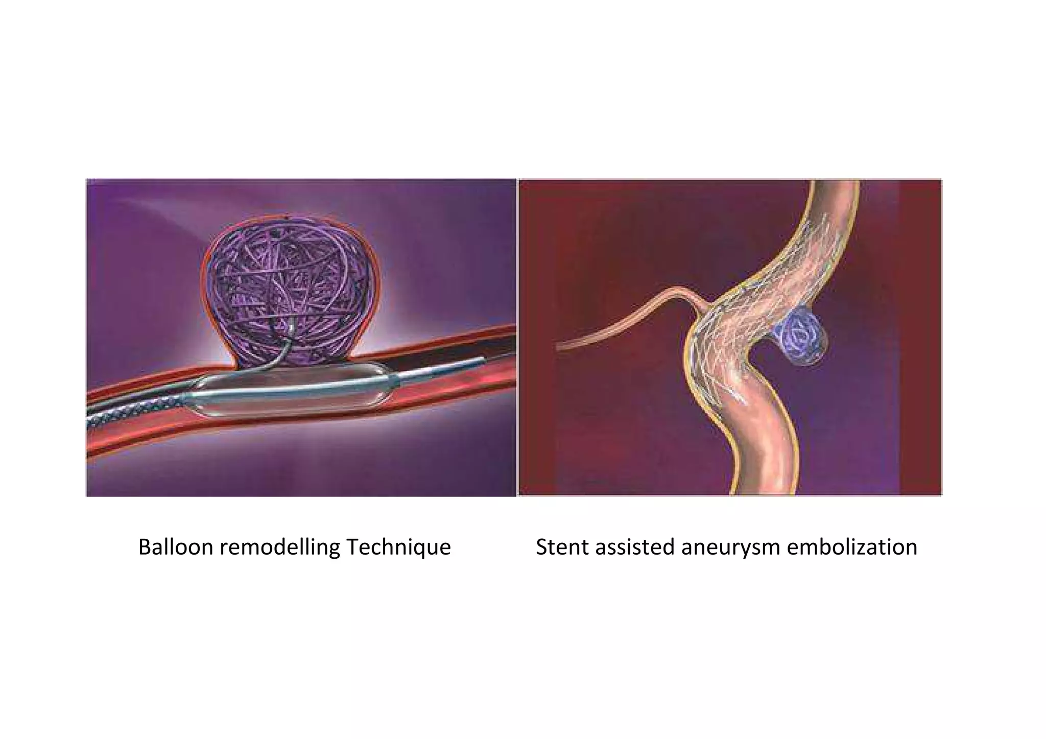 aneurysm emolization | PDF