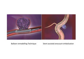 Balloon remodelling Technique   Stent assisted aneurysm embolization
 