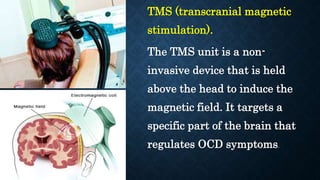 TMS (transcranial magnetic
stimulation).
The TMS unit is a non-
invasive device that is held
above the head to induce the
magnetic field. It targets a
specific part of the brain that
regulates OCD symptoms.
 