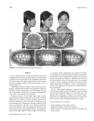 138 HONG, HEO, HA
Angle Orthodontist, Vol 75, No 1, 2005
FIGURE 13. Posttreatment facial and intraoral photographs.
Case 2
Case 2 demonstrates a 22-year-old Korean female who
complained of lip protrusion and crowding. The patient had
a skeletal Class I malocclusion. The mandibular permanent
left lateral incisor and right second premolar were missing,
and the mandibular primary right second molar was re-
tained (Figure 10).
Cephalometric analysis (Table 2) shows that the antero-
posterior skeletal measurements were generally within nor-
mal limits and the facial pattern was brachyfacial. The up-
per ﬁrst premolars and the lower prolonged retained decid-
uous molar were selected to be extracted.
Treatment progress. In the initial stage, upper anterior
lingual brackets interfered with the lower incisors when the
patient was in occlusion, causing a posterior open bite. To
avoid this interference, the lower arch was indirectly bond-
ed and banded ﬁrst. Progression through mushroom arch-
wires was initiated in the lower arch, starting with 0.012-
inch nickel titanium. After bite opening by intrusion of the
lower anterior teeth, Fujita lingual brackets were placed in-
directly from upper right ﬁrst molar to upper left ﬁrst molar.
A progress lateral cephalogram was exposed 18 months
into treatment to evaluate the anterior tooth movement dur-
ing retraction. This revealed that the inclination of the upper
incisors was protrusive (Table 2). Therefore, the lever-arm
and mini-implant system for the upper arch was designed
to achieve intrusive tipping retraction of the anterior teeth
without anchorage loss (Figures 11 and 12). The appliances
and the mini-implants were removed 33 months after the
start of treatment.
Results. After lingual orthodontic treatment with lever-
arm and mini-implant system, the patient’s convex proﬁle
was favorably improved (Figure 13). The teeth were well
aligned, and a satisfactory occlusion was achieved. Super-
impositions of cephalometric tracings (Figure 14) show the
tooth movement and skeletodental changes as follows:
During alignment and leveling
• slight uprighting of the upper incisors;
• signiﬁcant intrusion of the lower incisors;
• slight extrusion and mesial movement of the upper and
lower molars;
 