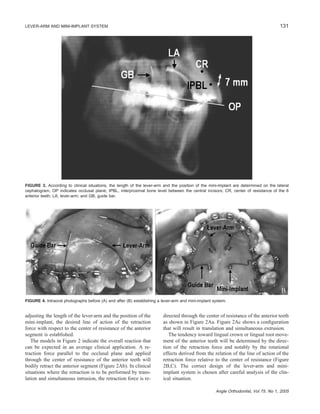 131LEVER-ARM AND MINI-IMPLANT SYSTEM
Angle Orthodontist, Vol 75, No 1, 2005
FIGURE 3. According to clinical situations, the length of the lever-arm and the position of the mini-implant are determined on the lateral
cephalogram. OP indicates occlusal plane; IPBL, interproximal bone level between the central incisors; CR, center of resistance of the 6
anterior teeth; LA, lever-arm; and GB, guide bar.
FIGURE 4. Intraoral photographs before (A) and after (B) establishing a lever-arm and mini-implant system.
adjusting the length of the lever-arm and the position of the
mini-implant, the desired line of action of the retraction
force with respect to the center of resistance of the anterior
segment is established.
The models in Figure 2 indicate the overall reaction that
can be expected in an average clinical application. A re-
traction force parallel to the occlusal plane and applied
through the center of resistance of the anterior teeth will
bodily retract the anterior segment (Figure 2Ab). In clinical
situations where the retraction is to be performed by trans-
lation and simultaneous intrusion, the retraction force is re-
directed through the center of resistance of the anterior teeth
as shown in Figure 2Aa. Figure 2Ac shows a conﬁguration
that will result in translation and simultaneous extrusion.
The tendency toward lingual crown or lingual root move-
ment of the anterior teeth will be determined by the direc-
tion of the retraction force and notably by the rotational
effects derived from the relation of the line of action of the
retraction force relative to the center of resistance (Figure
2B,C). The correct design of the lever-arm and mini-
implant system is chosen after careful analysis of the clin-
ical situation.
 