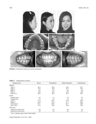 132 HONG, HEO, HA
Angle Orthodontist, Vol 75, No 1, 2005
FIGURE 5. Pretreatment facial and intraoral photographs.
TABLE 1. Cephalometric Summary
Measurement Norms Pretreatment Before Retraction Posttreatment
Skeletal
SNA (Њ)
SNB (Њ)
ANB (Њ)
FMA (Њ)
NPo-FH (Њ)
82.3
78.9
3.4
28.8
84.8
88.0
83.6
4.4
35.6
89.4
88.3
83.7
4.6
35.9
89.7
88.1
83.2
4.8
35.5
89.7
Dental
Overbite (mm)
Overjet (mm)
1-FH (Њ)
FMIA (Њ)
Interincisal (Њ)
Is-IsЈ (mm)a
2.3
3.2
111.3
59.8
124.1
31.9
1.0
5.0
124.3
53.5
109.2
28.5
1.9
5.0
114.0
61.7
127.7
30.0
2.7
4.5
109.2
68.0
138.8
28.2
Soft tissue
Upper lip to E-line (mm)
Lower lip to E-line (mm)
Ϫ0.9
0.6
4.0
5.5
4.8
5.2
2.3
0.1
a
Is-IsЈ, indicates upper incisor dental height.
 