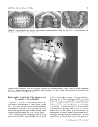 133LEVER-ARM AND MINI-IMPLANT SYSTEM
Angle Orthodontist, Vol 75, No 1, 2005
FIGURE 6. For en masse retraction, lever-arm and mini-implant system established in upper arch and 0.018 ϫ 0.018-inch stainless steel
closing-loop mushroom archwire placed in lower arch.
FIGURE 7. Lateral cephalogram taken after establishing a lever-arm and mini-implant system in case 1. The line of action of the retraction
force (LARF) passes through the center of resistance of the 6 anterior teeth (CR) and is parallel to the occlusal plane. In this case, bodily
retraction of the anterior teeth will be expected.
Determination of the length of the lever-arm and
the position of the mini-implant
The center of resistance of the unit to be moved is the
basic point for the arrangement of a force system. Vanden
Bulcke et al23
have concluded that the instantaneous center
of resistance for the 6 anterior teeth was located at 7.0 mm
apical to the interproximal bone level between the central
incisors (measured perpendicular to the occlusal plane).
Using the location of the center of resistance for the 6
anterior teeth deﬁned by Vanden Bulcke et al, the length
of the lever-arm and the position of the mini-implant are
determined on the lateral cephalogram before retraction
(Figure 3). A lever-arm, made of 0.9 mm stainless steel
wire, is soldered onto the mushroom archwire between the
lateral incisors and canines and the ﬁtting lever-arm length
is determined. The proper insertion site of the mini-implant
is measured from a guide bar made of 0.018 ϫ 0.018-inch
stainless steel wire and engaged in the molar bracket. The
mini-implants are inserted under local anesthesia directly
through the mucosa without any ﬂap dissection. The ﬁtting
implant length is determined by assessing the thickness of
 