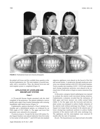 134 HONG, HEO, HA
Angle Orthodontist, Vol 75, No 1, 2005
FIGURE 8. Posttreatment facial and intraoral photographs.
the palatal soft tissue and the available bone quantity at the
desired implantation site. The mini-implant is inserted man-
ually with a screwdriver. Then, the desired lever-arm and
mini-implant system is completed (Figure 4).
APPLICATION OF LEVER-ARM AND
MINI-IMPLANT SYSTEM
Case 1
A 25-year-old Korean female presented with the chief
complaint of lip protrusion. The patient exhibited a convex
proﬁle and a super Class I molar relationship with a missing
mandibular right lateral incisor (Figure 5).
Cephalometric analysis disclosed a Class I skeletal rela-
tionship and a dolichofacial pattern, as evidenced by an
FMA angle of 35.6Њ (Table 1). The upper and lower ﬁrst
premolars were selected to be extracted.
Treatment progress. Except for the lower left canine, Fu-
jita lingual brackets were placed indirectly from ﬁrst molar
to ﬁrst molar in both arches24,25
and 0.018-inch slot standard
edgewise appliances were placed on the buccal of the ﬁrst
and second molars. A progression through mushroom arch-
wires was initiated starting with 0.012-inch nickel titanium.
Twelve months into treatment, 0.018 ϫ 0.018-inch stainless
steel closing mushroom archwires were placed in the oc-
clusal slots of both arches to begin en masse retraction (Fig-
ure 6).
At this point, a progress lateral cephalogram was exposed
to evaluate the anterior tooth movement during retraction.
Cephalometric evaluation revealed that the inclination of
both upper and lower incisors was within normal limits
(Table 1). For the upper arch, the lever-arm and mini-im-
plant system was designed to achieve bodily retraction of
the anterior teeth without anchorage loss (Figure 7), and a
lingual root torque bend was placed in the anterior part of
lower closing-loop mushroom archwire to achieve bodily
retraction of the anterior teeth with some anchorage loss.
The appliances and the mini-implants were removed 30
months after the start of treatment.
Results. The lip protrusion was improved and a favorable
 