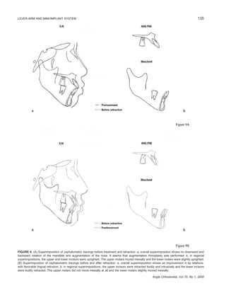 135LEVER-ARM AND MINI-IMPLANT SYSTEM
Angle Orthodontist, Vol 75, No 1, 2005
FIGURE 9. (A) Superimposition of cephalometric tracings before treatment and retraction: a, overall superimposition shows no downward and
backward rotation of the mandible and augmentation of the nose. It seems that augmentation rhinoplasty was performed; b, in regional
superimpositions, the upper and lower incisors were uprighted. The upper molars moved mesially and the lower molars were slightly uprighted.
(B) Superimposition of cephalometric tracings before and after retraction: a, overall superimposition shows an improvement in lip relations,
with favorable lingual retrusion; b, in regional superimpositions, the upper incisors were retracted bodily and intrusively and the lower incisors
were bodily retracted. The upper molars did not move mesially at all and the lower molars slightly moved mesially.
 