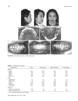 136 HONG, HEO, HA
Angle Orthodontist, Vol 75, No 1, 2005
FIGURE 10. Pretreatment facial and intraoral photographs.
TABLE 2. Cephalometric Summary
Measurement Norms Pretreatment Before Retraction Posttreatment
Skeletal
SNA (Њ)
SNB (Њ)
ANB (Њ)
FMA (Њ)
NPo-FH (Њ)
82.3
78.9
3.4
28.8
84.8
80.4
76.8
3.6
21.1
89.9
80.3
75.8
4.5
22.0
89.2
79.5
76.1
3.4
20.7
89.5
Dental
Overbite (mm)
Overjet (mm)
1-FH (Њ)
FMIA (Њ)
Interincisal (Њ)
Is-IsЈ (mm)a
2.3
3.2
111.3
59.8
124.1
31.9
4.2
5.7
123.6
57.5
113.9
29.8
0.9
8.6
123.3
56.2
112.9
30.6
1.0
2.4
111.4
53.5
122.2
29.3
Soft tissue
Upper lip to E-line (mm)
Lower lip to E-line (mm)
Ϫ0.9
0.6
4.4
4.9
4.4
4.7
2.3
2.3
a
Is-IsЈ, indicates upper incisor dental height.
 
