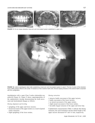 137LEVER-ARM AND MINI-IMPLANT SYSTEM
Angle Orthodontist, Vol 75, No 1, 2005
FIGURE 11. For en masse retraction, lever-arm and mini-implant system established in upper arch.
FIGURE 12. Lateral cephalogram taken after establishing a lever-arm and mini-implant system in case 2. The line of action of the retraction
force (LARF) passes inferior to the center of resistance of the 6 anterior teeth (CR). Intrusive tipping retraction of the anterior teeth is expected
with this conﬁguration.
interdigitation with a super Class I molar relationship was
achieved (Figure 8). Figure 9 shows superimpositions of
the cephalometric tracings demonstrating the tooth move-
ment and skeletodental changes as follows:
During alignment and leveling
• uprighting of the upper and lower incisors;
• mesial movement of the upper molars as a result of partial
canine retraction;
• slight uprighting of the lower molars.
During retraction
• intrusive bodily movement of the upper incisors;
• bodily movement of the lower incisors;
• no mesial movement of the upper molars;
• slight mesial movement of the lower molars;
• favorable lingual retrusion of the upper and lower lips.
Cephalometric measurements (Table 1) indicate that during
retraction, the axial inclination and the dental height of the
upper incisors decreased 4.8Њ and 1.8 mm, respectively.
 