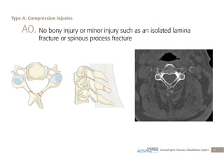 Cervical Spine Fractures Classiﬁcation System 13
A0. No bony injury or minor injury such as an isolated lamina
fracture or spinous process fracture
Type A: Compression injuries
 