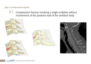 Cervical Spine Fractures Classiﬁcation System14
A1. Compression fracture involving a single endplate without
involvement of the posterior wall of the vertebral body
Type A: Compression injuries
 