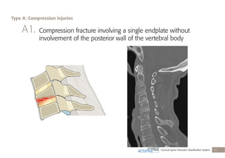 Cervical Spine Fractures Classiﬁcation System 15
A1. Compression fracture involving a single endplate without
involvement of the posterior wall of the vertebral body
Type A: Compression injuries
 