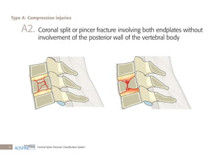Cervical Spine Fractures Classiﬁcation System16
A2. Coronal split or pincer fracture involving both endplates without
involvement of the posterior wall of the vertebral body
Type A: Compression injuries
 