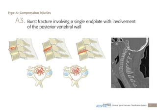 Cervical Spine Fractures Classiﬁcation System 17
A3. Burst fracture involving a single endplate with involvement
of the posterior vertebral wall
Type A: Compression injuries
 