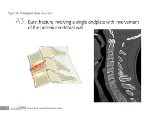 Cervical Spine Fractures Classiﬁcation System18
A3. Burst fracture involving a single endplate with involvement
of the posterior vertebral wall
Type A: Compression injuries
 