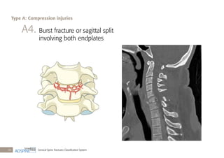 Cervical Spine Fractures Classiﬁcation System20
A4. Burst fracture or sagittal split
involving both endplates
Type A: Compression injuries
 