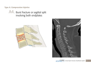Cervical Spine Fractures Classiﬁcation System 21
A4. Burst fracture or sagittal split
involving both endplates
Type A: Compression injuries
 