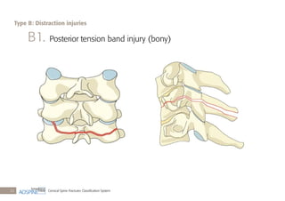 Cervical Spine Fractures Classiﬁcation System22
B1. Posterior tension band injury (bony)
Type B: Distraction injuries
 