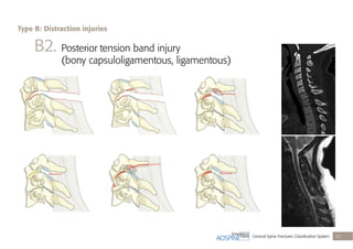 Cervical Spine Fractures Classiﬁcation System 23
B2. Posterior tension band injury
(bony capsuloligamentous, ligamentous)
Type B: Distraction injuries
 