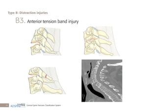 Cervical Spine Fractures Classiﬁcation System24
B3. Anterior tension band injury
Type B: Distraction injuries
 