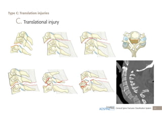 Cervical Spine Fractures Classiﬁcation System 25
C. Translational injury
Type C: Translation injuries
 