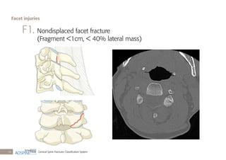 Cervical Spine Fractures Classiﬁcation System26
F1. Nondisplaced facet fracture
(Fragment <1cm, < 40% lateral mass)
Facet injuries
 