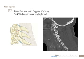 Cervical Spine Fractures Classiﬁcation System 27
F2. Facet fracture with fragment >1cm,
> 40% lateral mass or displaced
Facet injuries
 
