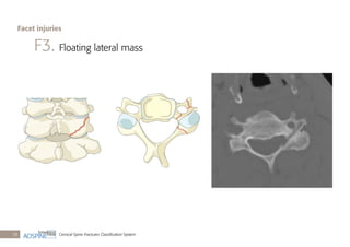 Cervical Spine Fractures Classiﬁcation System28
F3. Floating lateral mass
Facet injuries
 